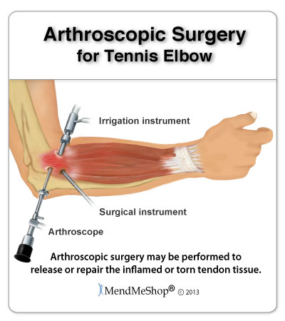 Tennis Elbow arthroscopic surgery - 90% of people suffering from Tennis Elbow can heal through conservative treatment methods.