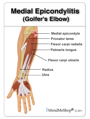 golfer elbow anatomical image