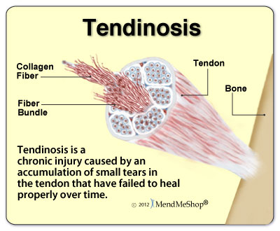 golfers elbow injury and tendinosis