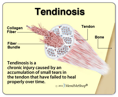 tennis elbow injury and tendinonpath