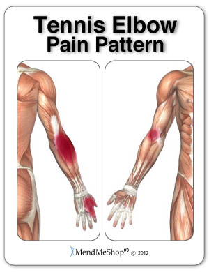 Tennis Elbow, Wrist, Forearm pain pattern